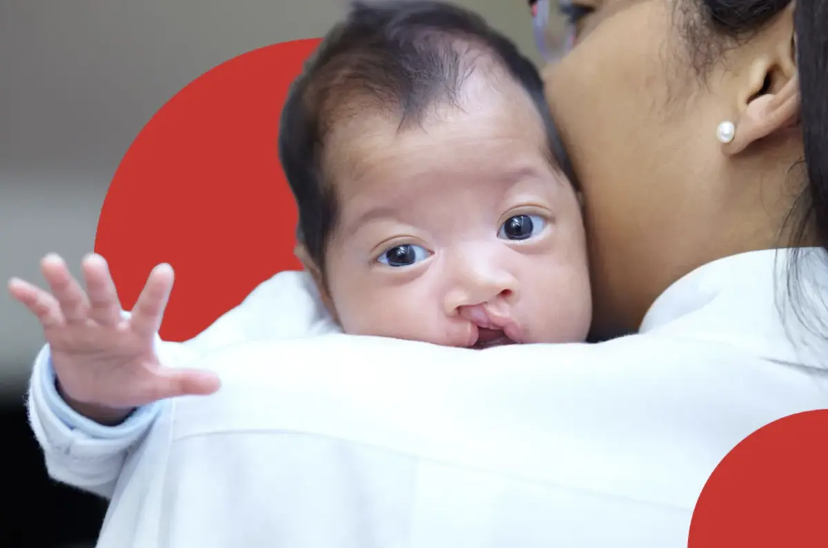 Corporativo Kosmos apoya con atención nutricional a niños con labio y paladar hendido. 